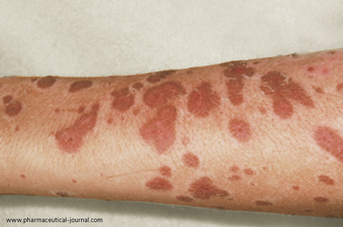 Разпознайте синдрома на Стивънс Джонсън, който може да предизвика кожни инфекции