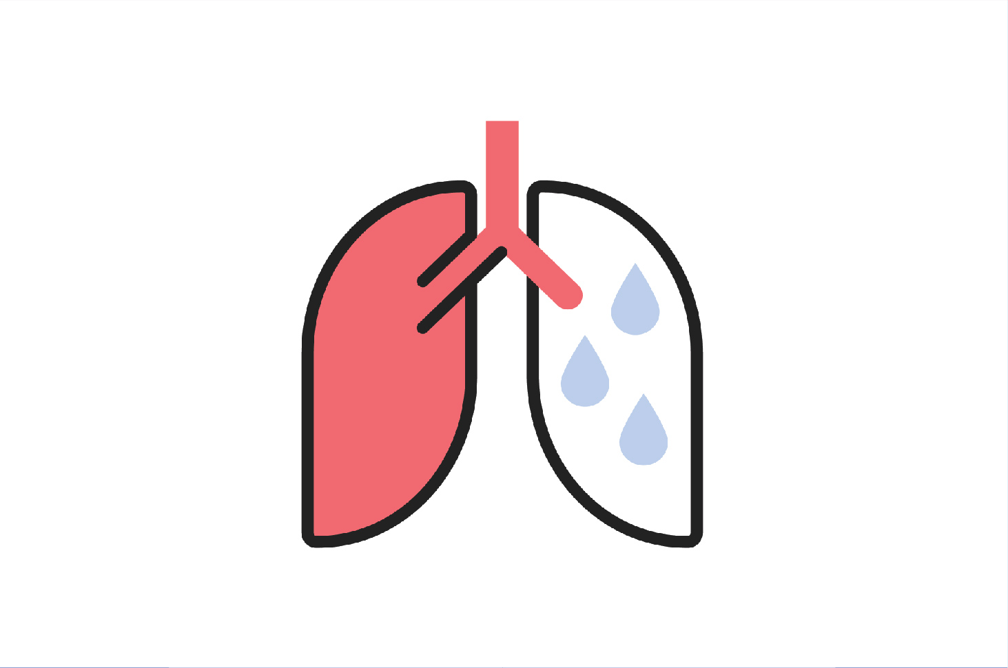Това е обяснение на термина мокри бели дробове