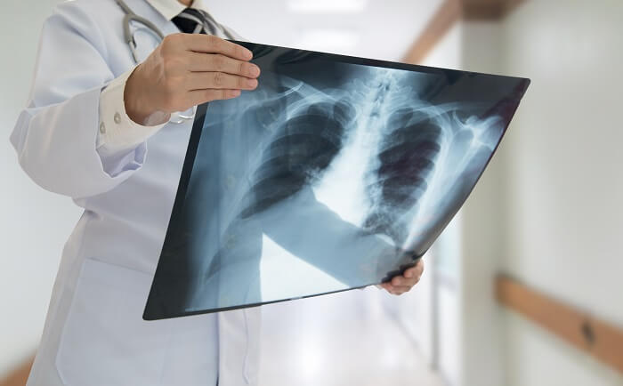 Akciğer Röntgeni Çekmeden Önce Bilmeniz Gereken 4 Şey