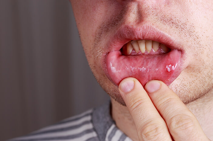 口の中で起こりやすい7つの病気を認識する