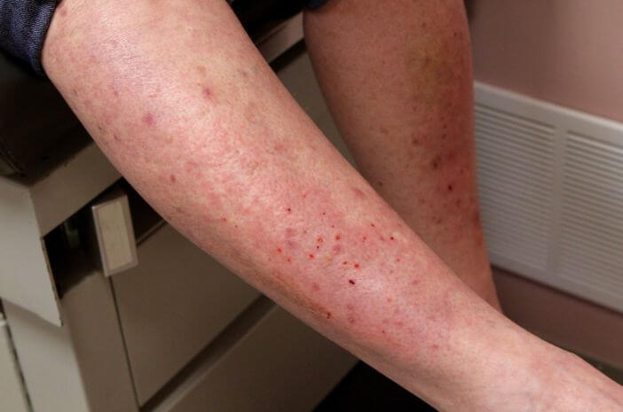Изгаряща и образуваща мехури кожа, това са симптоми на дерматит Herpetiformis