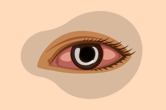 目の白い斑点、角膜潰瘍に注意してください
