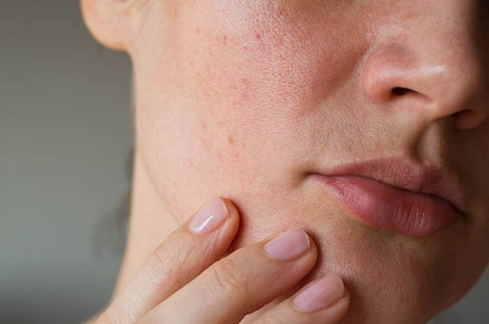 Хипопаратиреоидизмът може да причини суха лющеща се кожа?