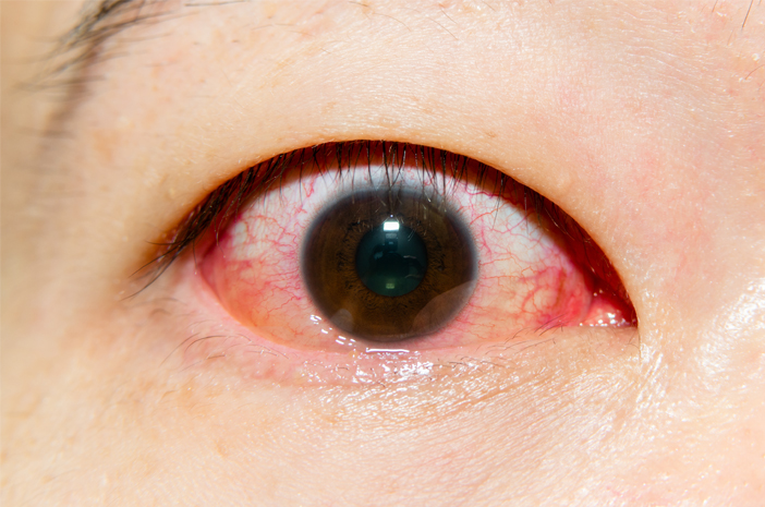 注意してください、これは目の血管の破裂の原因です