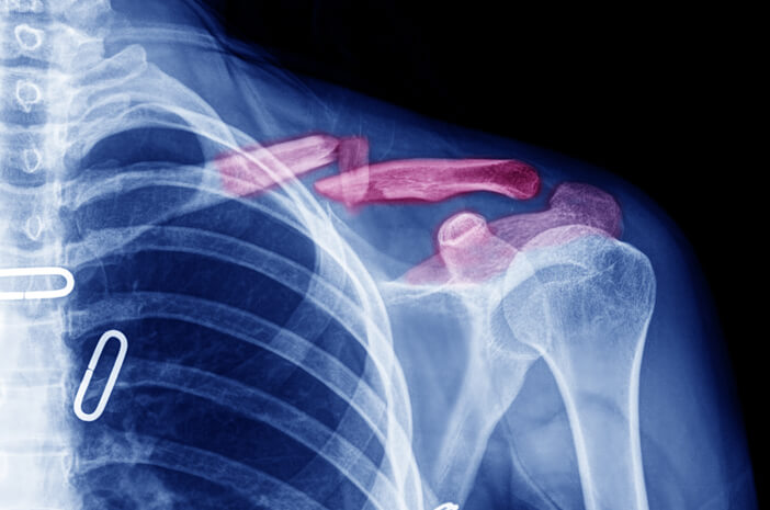 Bolehkah patah tulang selangka dirawat tanpa pembedahan?