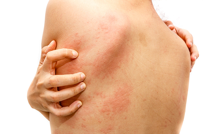 Ecco 3 tipi di infezioni della pelle causate da parassiti