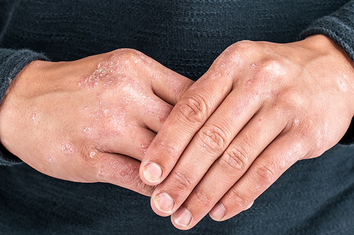 5種類の皮膚がんの症状を認識する方法は次のとおりです