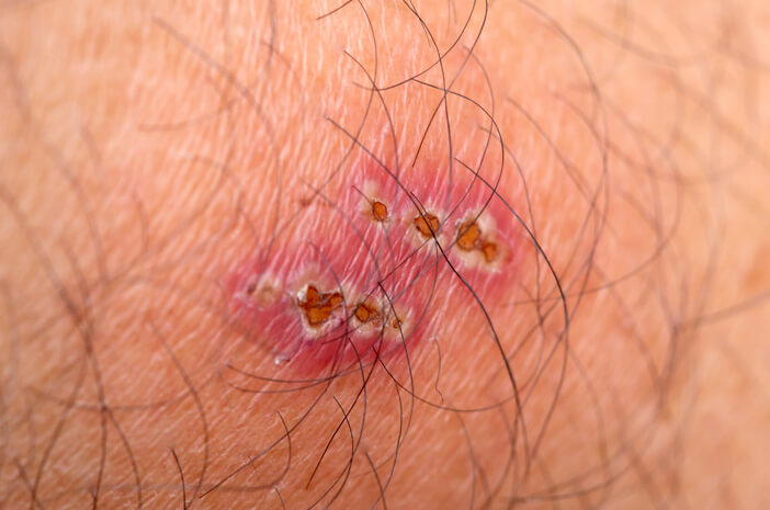 細菌性皮膚感染症である膿痂疹の詳細