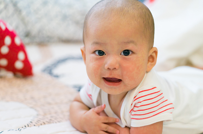 5 Cara Mengatasi Titik Merah pada Kulit Bayi