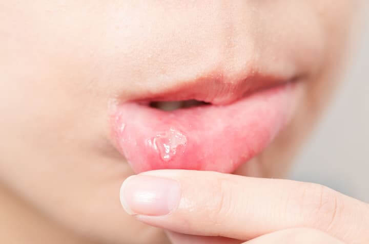 頻繁に再発する口内炎を防ぐ方法