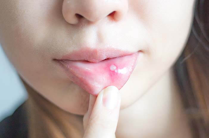 هل صحيح أن فيتامين سي كافٍ لعلاج قرح الفم؟