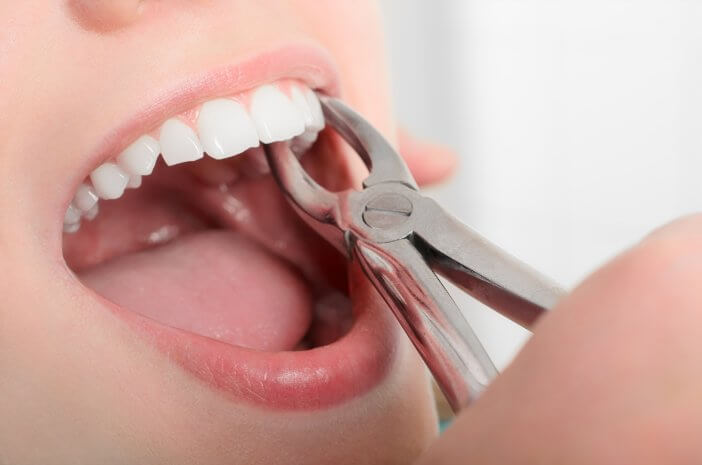 3 усложнения, които могат да възникнат при екстракция на зъб от мъдрост
