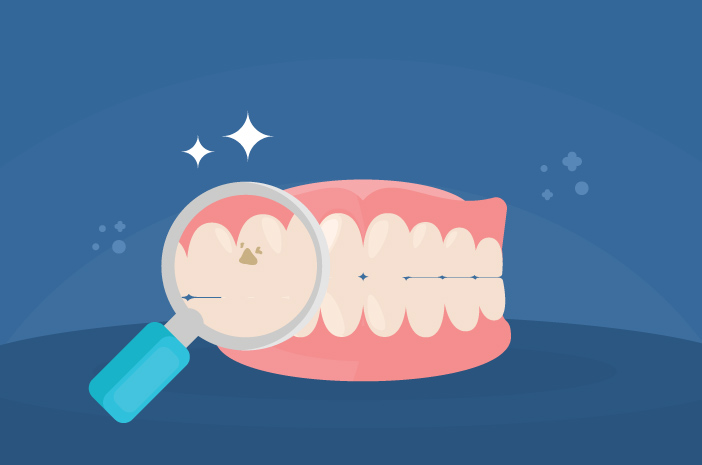 虫歯の原因は何ですか？