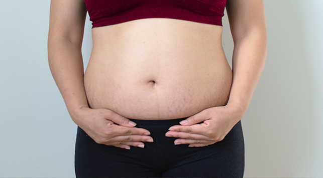 9 съвета как да се отървете от стрии след бременност