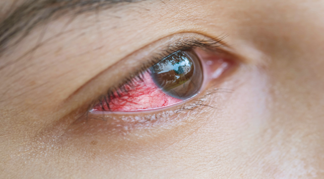6 Рискове от болка в очите поради подметки