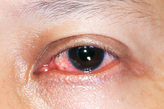 تعرف على 4 أنواع من الالتهابات التي يمكن أن تهاجم العيون