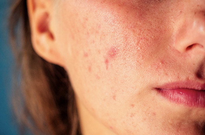 10 симптома на лупус при жените, които трябва да знаете