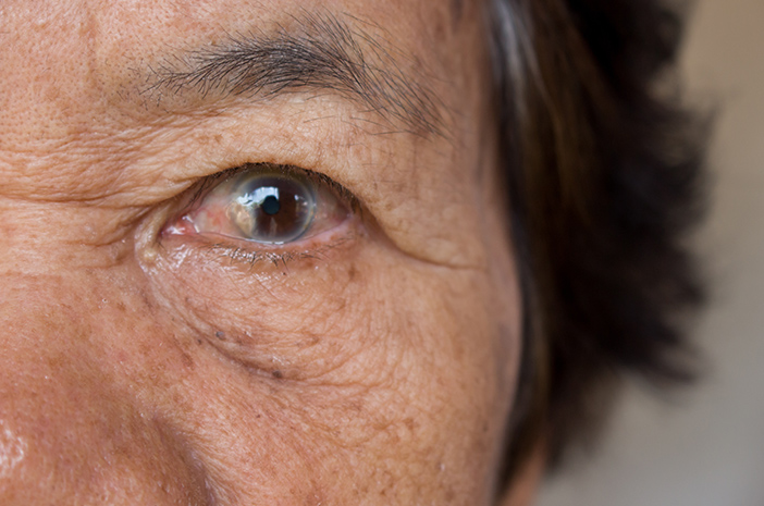 Сенилната болест на катаракта може да предизвика глаукома
