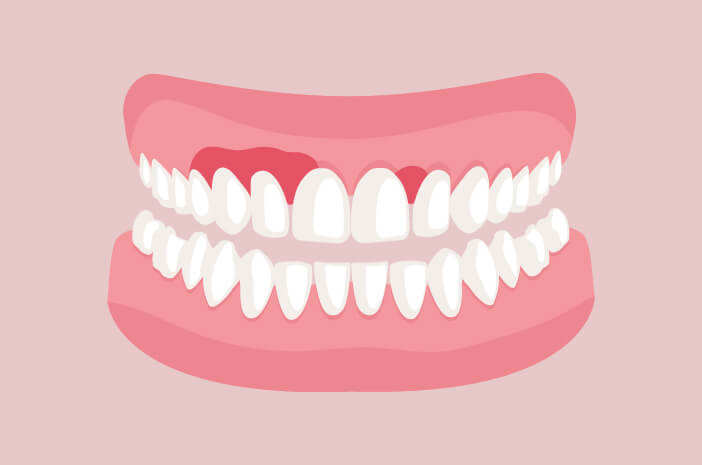 これらはしばしば無視される歯肉炎の原因です