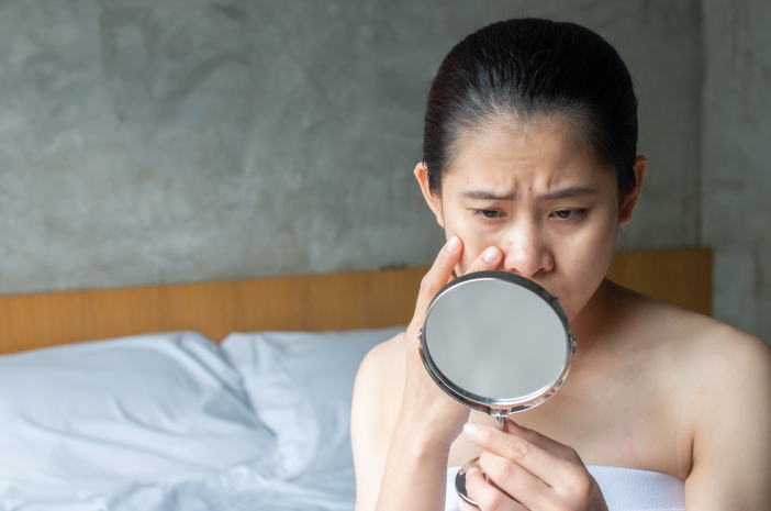 Conoscere 5 cause dell'acne di pietra