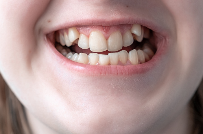 4 حقائق مثيرة للاهتمام حول أسنان الجنسول