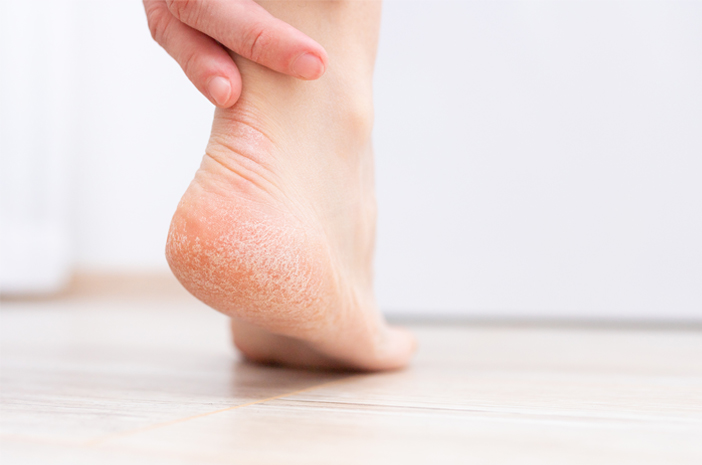 كيفية التعامل مع جلد القدم المتشقق